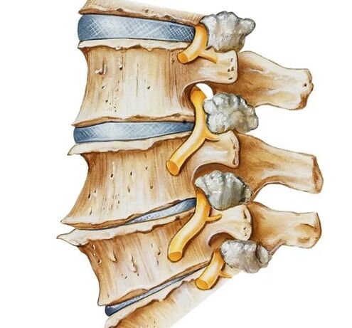Pinching the nerve into the spine
