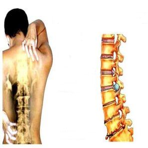 Stages of osteochondrosis