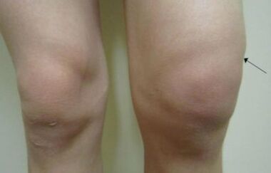 Clinical manifestations of knee arthrosis joint