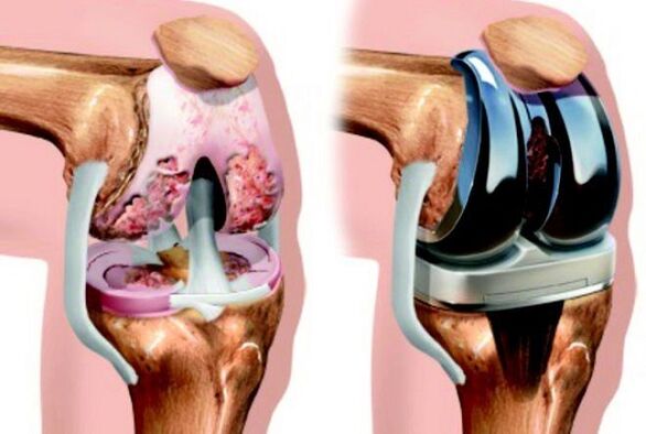 Before and after the knee endoprothetics with arthrosis