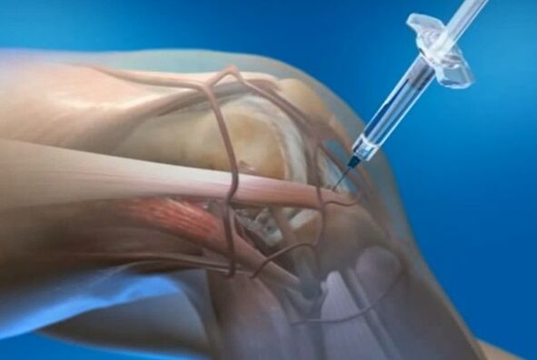 Intracecular injections for knee arthrosis joint
