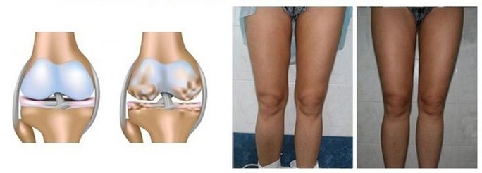 defeat of osteoarthritis of the knee joint with osteoarthritis