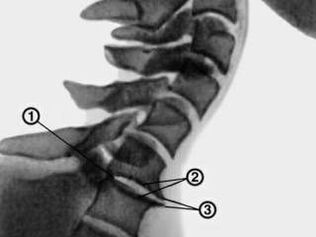 Osteophytes in cervical vertebrae with osteochondrosis